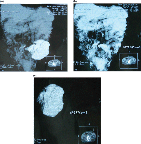 Figure 2. (a) Marking the volumes of the abdominal cavity and hernia. (b) Measuring the volume of the abdominal cavity. (c) Measuring the herniary volume.