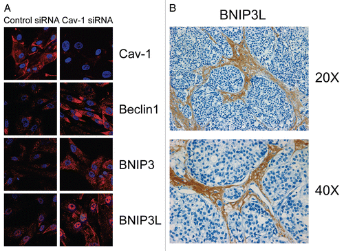 Figure 3 Acute knock-down of Cav-1 in human stromal fibroblasts activates autophagy and mitophagy: implications for human breast cancer. (A) Acute loss of Cav-1 increases the expression of autophagic markers. hTER T-fibroblasts were treated with Cav-1 siRNA or control (CTR) siRNA. Cells were fixed and immuno-stained with antibodies against Beclin1, BNIP3 and BNIP3L. DAPI was used to visualize nuclei (blue). Importantly, paired images were acquired using identical exposure settings. Original magnification, 40x. Note that acute Cav-1 knockdown is sufficient to greatly increase the expression levels of all the autophagy/mitophagy markers we examined. (B) BNIP3L is highly increased in the stroma of human breast cancers that lack stromal Cav-1. Paraffin-embedded sections of human breast cancer samples lacking stromal Cav-1 were immuno-stained with antibodies directed against BNIP3L. Slides were then counter-stained with hematoxylin. Note that BNIP3L is highly expressed in the stromal compartment of human breast cancers that lack stromal Cav-1. Original magnification, 20x and 40x, as indicated. Images were reproduced from the references Citation7 and Citation8, with permission.