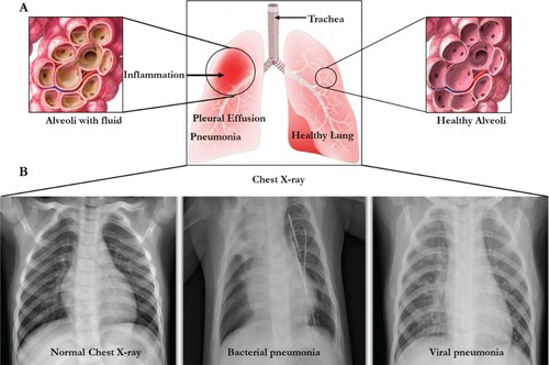 Figure 1. The lungs and chest X-rays showing inflammation leading to pneumonia. (A) The lung presented with inflammation (left) and normal right lung. (B) The chest X-rays showing the normal chest with clear lungs without unusual opacification, Bacterial pneumonia displaying focal lobar consolidation in the right upper lobe, and Viral pneumonia showing diffuse interstitial patterns in the two lungs.