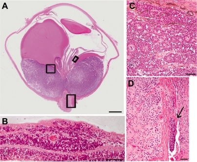 Figure 2 Histopathology of the enucleated eye. Hematoxylin and eosin staining. A) Retinal detachment with a huge choroidal mass invading the optic nerve head. Bar indicates 3 mm. B) Tumor cells invaded the ganglion cell layer without forming masses. Bar indicates 50 um. C) Tumor cells were tightly packed, and contained large hyperchromatic nuclei and scant cytoplasm. Rosette formation was observed in the choroidal mass. Bar indicates 50 um. D) Tumor cells infiltrated the parenchyma of the optic nerve and subarachnoid space (arrow). Bar indicates 50 um.