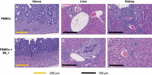 Figure 4. Histology of B7-H4 TCE treated mice. Representative areas of uterus show mild chronic inflammation of endometrium and myometrium in PBMC-treated mice (A, top left), but more pronounced, full-thickness chronic inflammation in the uteri of PBMC with B0/+-treated mice (B, bottom left). Similarly, livers of mice receiving PBMC only show only mild, focal perivascular chronic inflammatory infiltrates (C, top middle) while livers from treated mice show more pronounced portal inflammation with evidence of sclerosing cholangitis (D, bottom middle). Kidneys of both PBMC and treated mice (E, F, top right, bottom right respectively) show only small, rare, areas of mild chronic inflammation.