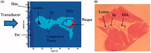 Figure 5. Correlation between the simulation results and gross histology. (A) Simulation result of the thermal dose within the prefocal region, the arrow points to the prefocal damage. (B) Prefocal thermal damage within the same region as shown from gross histology. FA, femoral artery; Sp, saphenous artery.