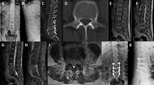 Figure 2 Typical cases of perioperative quadruple chemotherapy. Preoperative X-ray: a stenosis of the intervertebral space of L4/5 accompanied by a beak-like spur in front of the infected vertebral body (A and B); preoperative CT: there is bone destruction of adjacent vertebral bodies in the intervertebral space of L4/5, forming “lace vertebra” (C and D); preoperative MRI: destruction of L4/5 and adjacent vertebrae, inflammatory tissue formation in spinal canal, inflammatory tissue of psoas major muscle, paraspinal inflammation, and compression of posterior dural sac and nerve root (E–I); X-ray immediately postoperatively: a firmly installed internal fixation system (J and K).