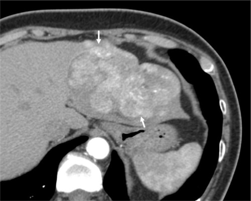 Figure 6 Seventy-one-year-old female demonstrating nonrim arterial phase hyperenhancement.