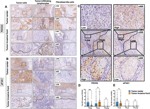 Figure 1 Representative images showing immunohistochemical staining of PDCD4 (A and D) and eIF4A1 (B and E) in TCs, TILs and FLCs in tumor center or invasive front of OSCC tissues. The staining of PDCD4 and eIF4A1 showed an opposite trend in different differentiated regions of the same part of the sample (C). *** and ns represent that differences are considered statistically significant with P<0.05 and no significance, respectively.