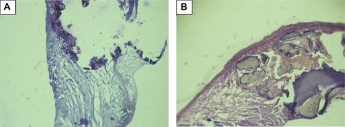 Figure 1 Macroscopic calcification of bioprosthetic leaflet samples, stained with hematoxylin-eosin, with original magnification ×100. The two figures (A and B) show the morphology of calcification.