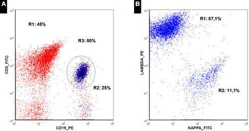 Figure 1 Flow cytometry of mantle cell lymphoma in the peripheral blood (2015) shows CD19/CD5 coexpression (depicted in dark blue) (A) and λ light-chain restriction (B).