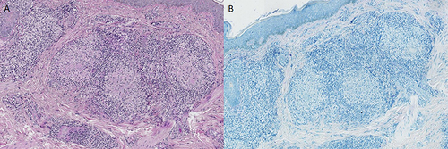 Figure 3 Acid-fast staining and PAS staining in granulomatous rosacea. (A) Acid-fast staining did not detect any acid-fast bacilli; (B) PAS staining showed negative results.