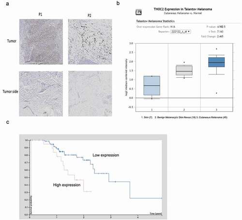 Figure 1. THOC2 was upregulated in melanoma.(a) IHC staining for THOC2 in melanoma tissues and adjacent normal tissues. (b) Oncomine expression analysis of THOC2 in human melanoma vs. normal skin tissues and benign melanocytic skin nevus. (c) Melanoma patients with high THOC2 expression had a poor prognosis compared to thelow THOC2 expression group. *P < 0.05.