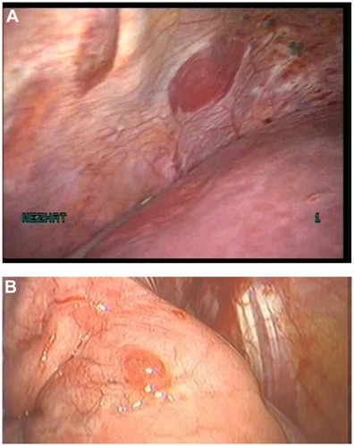 Figure 6 (A) Endometriosis of the thoracic wall. (B) Endometriosis of the lung parenchyma.