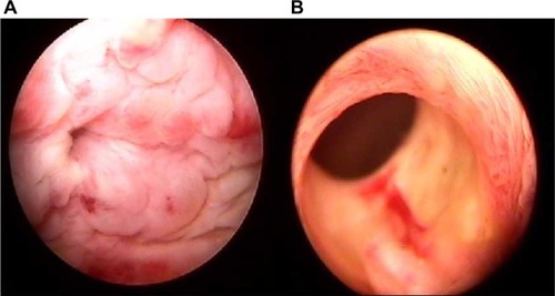 Figure 1 Cystoscopy revealed an erythematous mucosal lesion over the anterior wall and a small prostate.