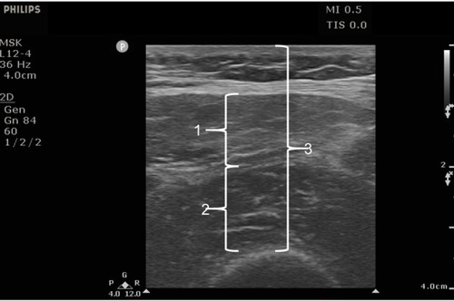 Figure 1 Ultrasound of the dominant quadriceps. Qci was defined as the ratio of total quadriceps thickness [rectus femoris thickness (1) + vastus intermedius thicknesses (2)] divided by total anterior thigh thickness (3). All measurements were performed on a single imaginary line connecting the skin and most anterior part of the femur.