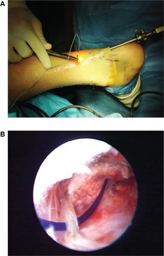 Figure 4 A modified Bunnel suture configuration was used for the procedure. A) Initially, the suture passes from the superomedial stab incision (portal 1). B) The suture is carried distally with zig-zag fashion in the sequence of the number of the stab incisions under control of endoscopy.