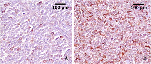 Figure 3. A: Neoplastic cells expressing Melan-A (3,3′-Diaminobenzidine indirect immunohistochemistry. Hematoxylin in counterstain) with strong label intensity in some cells. (original magnification 40×). B: Neoplastic cells expressing S100 (3,3′-Diaminobenzidine indirect immunohistochemistry. Hematoxylin in counterstain) with strong label intensity diffuse in cellular proliferation. (original magnification 40×).