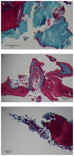 Figure 2 (A) Filament cross, oblique, and lateral sections, from a specimen collected from patient 1 showing round, elliptical/elongated, bean-like, or curved morphology. Note the hollow medulla and surrounding cortex. Cytokeratin (CK) AE1/AE3 staining. 100× magnification. (B) Specimen from patient 1, demonstrating irregular, patchy keratin staining with CK AE1/AE3, longitudinal section. Note most filaments staining positive for keratin (dark brown). 100× magnification. (C) Specimen from patient 1, demonstrating irregular, patchy keratin staining with CK AE1/AE3. Cross, oblique, and longitudinal sections. Note most filaments staining negatively for keratin. 400× magnification. (D) Longitudinal section of filament from patient 1. Note retained nuclei, central medulla, and patchy keratin staining with CK AE1/AE3. 400× magnification. (E) Sectioned filament from a specimen from patient 1, which upon gross microscopic examination demonstrated floral-like or stellate formations. Note retained nuclei within tentacle-like filaments with tapered ends. CK AE1/AE3 staining. 400× magnification. (F) Sectioned callus from patient 1, showing filaments stemming from the stratum basale with evolution inwards towards the dermis. Note filament sections with hollow medulla alongside the stratum basale. CK AE1/AE3 staining. 100× magnification. (G) Gömöri trichrome collagen-positive section of activated fibroblasts with filamentous inclusions from patient 2. Collagen stains green, keratin stains red. Growth of filaments was upwards toward the external surface. 400× magnification. (H) Ruptured keratin projection from both external and internal surfaces from a specimen collected from patient 2, with areas of fibroblast proliferation stained green. Gömöri trichrome stain. 100× magnification. (I) Section from patient 2 stained with Gömöri trichrome, demonstrating both keratin (red) and collagen (green) filament cross-sections, with most filaments associated with the external callus surface. 100× magnification. (J) Gömöri trichrome stain of specimen from patient 2, demonstrating filaments in longitudinal, oblique, and cross-sections close to and within collagen-positive fibroblast collections (green). Note presence of filament cross-sections staining positively for keratin (red). 400× magnification. (K) Bovine digital dermatitis (BDD) filament, longitudinal section, showing positive CK AE1/AE3 staining. 100× magnification. (L) BDD filament, longitudinal section, showing negative CK AE5/AE6 staining. 100× magnification.