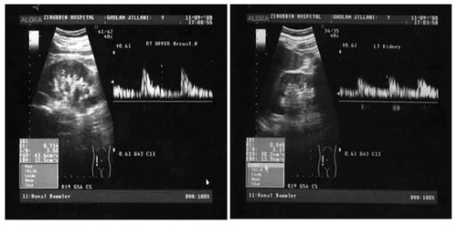 Figure 4 (A) Patient presents with acute right sided renal colic. Spectral waveform from the arcuate arteries of the upper pole of right kidney shows elevated RI of 0.714. Spectral waveform from the arcuate arteries of the mid pole of left kidney shows normal RI of 0.55. In this case both RI and delta RI are elevated.