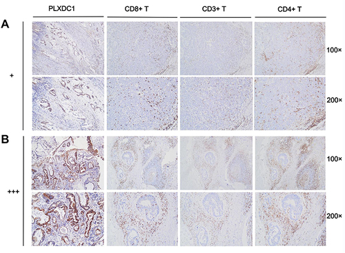 Figure 8 Immune cell infiltration in PLXDC1 high and low expression groups. (A) Infiltration of CD8+ T cells, CD3+ T cells and CD4+ T cells in PLXDC1 high expression group (+). (B) Infiltration of CD8+ T cells, CD3+ T cells and CD4+ T cells in PLXDC1 low expression group (+++).