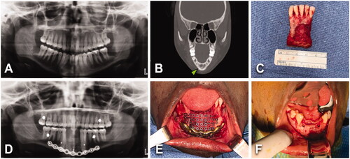 Figure 5. (A, B) A 17-year-old female with an asymptomatic 3.5 × 1.9 cm2 unicystic ameloblastoma of anterior mandible (green arrowhead). No past-medical history or tobacco/alcohol consumption. BMI of 25 kg/m2. (C–E) Lesion was treated with segmental mandible resection, reconstruction plate, non-vascularized bone graft from left iliac crest. No tracheostomy was required. Length of stay of 2 days. No postoperative complications. (F) Four months after primary surgery, patient got 2 tapered screw-vent (3.7 × 11.5) dental implants in sites 23 and 26.