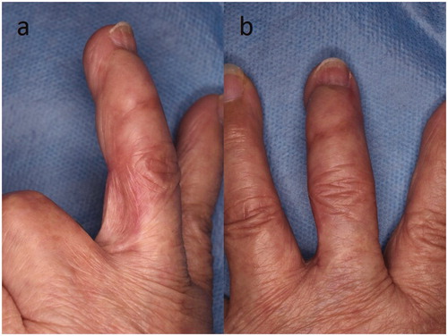 Figure 3. (a–b) Six months after the operation.