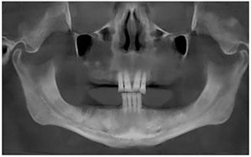 Figure 4 DVT-CI=2, cortical bone with resorbed cavities or residues of one to three sizes and small size.