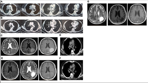 Figure 1 Baseline before immunotherapy. (A) 2 cycles after immunotherapy. (B) November 2021, cystic brain metastasis. (C) February 2022, 3 months after cystic brain metastasis. (D) February 2022, chest CT after radiotherapy for brain lesions. (E) May 2022, chest CT of recurrence of the right hilar of the right lung nodules. (F) November 2022, 1 year after cystic brain metastasis. (G).