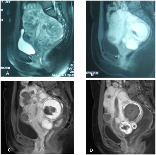 Figure 1. Magnetic resonance image (MRI) obtained from a 26-year-old patient with diffuse uterine leiomyomatosis (DUL). (A) The pre-HIFU T2- weighted images showed that the uterus was pervaded with tumors of varied sizes in the myometrium. The size of the enlarged uterus, measuring 104 mm × 110mm × 103 mm, corresponded to that of 16 weeks of gestation. (B) Pre-HIFU contrast enhanced MRI revealed significant enhancement of leiomyomas. (C) Post-HIFU contrast enhanced MRI revealed non-perfused leiomyomas that distributed along the anterior wall. (D) Contrast enhanced MRI after second HIFU revealed non-perfused leiomyomas that distributed along both the anterior and posterior walls.