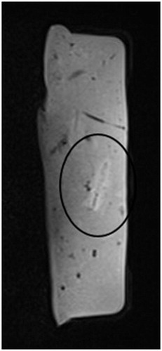 Figure 4. Image acquired 15 min after ablation (VIBE, 16 gauge). After tissue cooling, the area around the applicator appears slightly hyperintense.