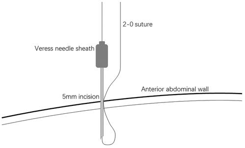 Figure 1. Thread the suture through the Veress needle sheath.