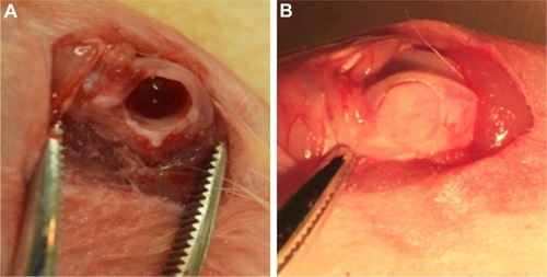 Figure 2 Surgical procedures.Notes: (A) Critical-sized defects created on a rat femur. (B) Bone scaffold materials implanted into the defect.