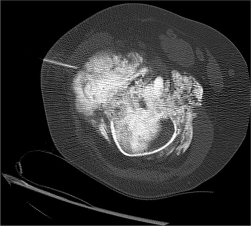 Figure 3 Distal femur CT biopsy.