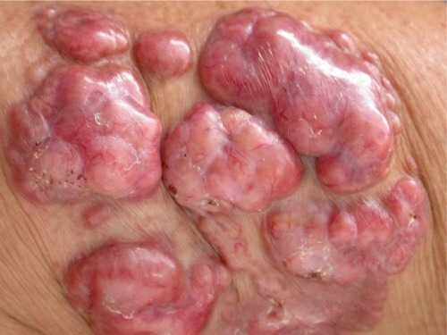 Figure 2 Typical primary fibrous appearance, with nodular plaques covered by smooth and shiny skin, with small exulcerated areas and visible telangiectasias.