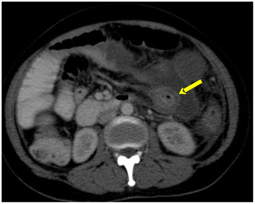 Figure 8a: Axial CT showing bulls-eye or target appearance in which there are alternating layers of high and low attenuation due to mural hyperenhancement and submucosal oedema (arrow)