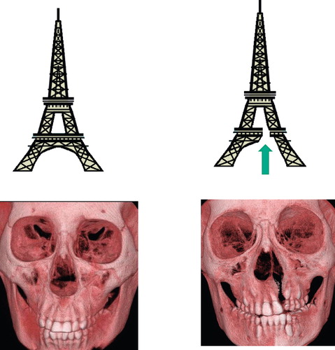 Figure 1.  Asymmetrical structures are susceptible to external forces (upper row). A building lacking part of its structure (above right) is expected to yield to less force than its intact counterpart (above left). Similarly, skulls with unilateral complete cleft palate are expected to be more susceptible to fractures than intact skulls (lower row).