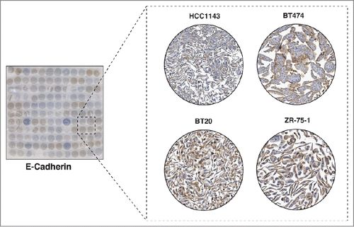 Figure 5. Immunocytochemical staining of E-Cadherin. The left panel shows a CMA slide stained with a monoclonal antibody against E-Cadherin. The panel on the right shows a magnified view of 4 representative cell lines showing different levels of expression of E-Cadherin. The Basal A breast cancer cell line, HCC1143 cell line showed low expression of E-Cadherin. However, 2 luminal cell lines, BT474, ZR-75-1 and one basal cell line BT20 showed medium to high expression level of E-Cadherin.
