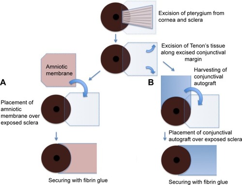 Figure 2 Schematic drawing of pterygium excision with amniotic membrane transplantation (A) and conjunctival autografting (B).