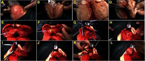Figure 1 Surgical procedure of laparotomic double-flap adenomyomectomy. (A) Diluted pituitrin was injected into uterine wall; (B and C) An incision was made in the serosal surface midline of uterine fundus by using scalpel and continued along the sagittal direction until the uterine cavity was reached; (D and E) Adenomyomatous tissues were grasped with forceps, identified, and excised from the surrounding myometrium; (F) The endometrial lining was approximated with interrupted sutures of 3–0 Vicryl; (G and H) The first flap in one side wall of the uterus was brought into the second flap in another side of the uterine wall so that the other side wall of the uterus was covered; (I, J, K and L) The second flap in another side of the uterine wall was brought to cover the first flap in one side wall of the uterus. Before overlapping occurred, the serosal surface of the underlying flaps was stripped to ensure that only myometrial tissue flaps overlapped.