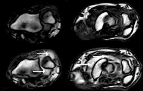 Figure 2 Patient with rheumatoid arthritis in clinical remission. Axial T1-weighted MR images of two sections of the wrist (left: distal radioulnar joint; right: intercarpal joints) with pre-contrast images in the upper row and post-contrast (after intravenous gadolinium contrast injection) images in the lower row. Images show considerable synovitis (arrows).