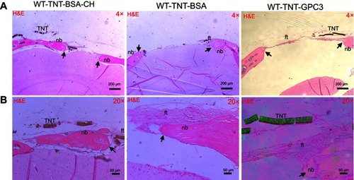 Figure 5 Histological (H&E) images showing bone regeneration in the critical-sized defects (CSDs) of the three wildtype groups at day 90 post-operatively at (A) a low magnification (×4) and (B) a high magnification (×20). Images A and B were prepared from different slices of the same CSD (for each group) that displayed the features most clearly at each magnification. Black arrows mark the new bone edge.Notes:  WT-TNT-BSA-CH, wildtype mice in which Titania nanotubes were loaded with bovine serum albumin and also coated with chitosan; WT-TNT-BSA, Wildtype mice in which Titania nanotubes were loaded with bovine serum albumin but not coated with chitosan; WT-TNT-GPC3, Wildtype mice in which Titania nanotubes were loaded with glypican 3 protein.Abbreviations: nb, new bone; ft, fibrous tissue; TNT, Titania nanotube (delaminated); WT, wildtype; BSA, bovine serum albumin; TNT, Titania nanotube; CH, chitosan; GPC3, glypican 3 protein.