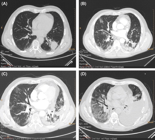 Figure 2. Radiographic (thoracic CT) development and progression of pneumonitis and pulmonary fibrosis in the period January (pre-therapy) to August (four month post-therapy) 2011. A. 4 January 2011 (without intravenous contrast). Before commencing therapy. Tumor lower left lobe. B. 30 May 2011. One month and a half post-therapy. Left lung; regression of tumor, ground-glass opacity, consolidation and air bronchogram consistent with radiation sequelae. Right lung; ground-glass opacity consistent with radiation pneumonitis. Incipient lung fibrosis with traction bronchiectasis. CTC grade 1. C. 8 July 2011. Increasing consolidation and fibrosis. CTC grade 2. D. 16 August 2011 (without intravenous contrast). Development of a left-sided pleural effusion and basal atelectasis. Right lung with increased ground-glass opacity. Fibrosis further progressed. CTC grade 3. *CTC: Common Toxicity Criteria for Adverse Events (version 4.03, 2010), pulmonary fibrosis.