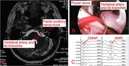 Figure 1 Microvascular decompression of the facial nerve.