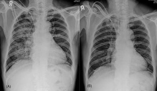 Figure 1. Chest radiograph on admission showing diffuse infiltration in the right lung field (A); follow-up chest radiograph on day 14 showing resolution of the infiltration after plasmapheresis and pulse methylprednisolone therapy (B).