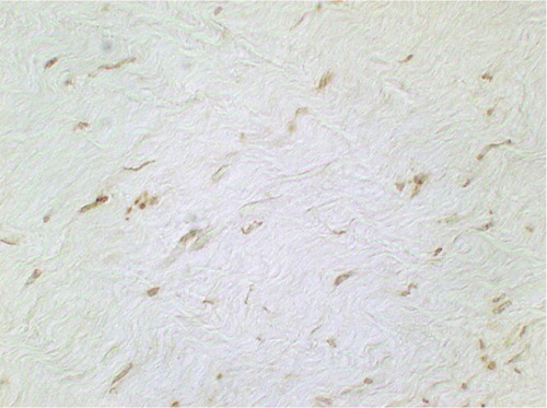 Figure 8. Figure 8. TUNEL-positive cells at 3 weeks after RF treatment with permanent immobilization: the nuclei are mainly spindle-shaped (original magnification: × 750).