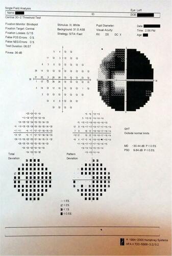 Figure 3 Humphrey’s visual field analyser charts of a patient with cup-disc ratio 0.9 showing a biarcuate scotoma in 30–2 visual field charting in left eye.