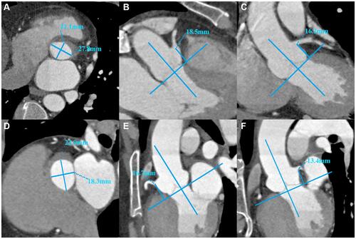 Figure 2 Computed tomography angiographic double oblique transverse images of the aortic annulus and coronary ostia height in a 53-year-old male (A) Aortic annulus dimension; (B) Right ostia to annulus; (C) Left coronary ostia to annulus) and 54-year-old female (D) Aortic annulus dimension; (E) Right ostia to annulus; (F) Left coronary ostia to annulus.