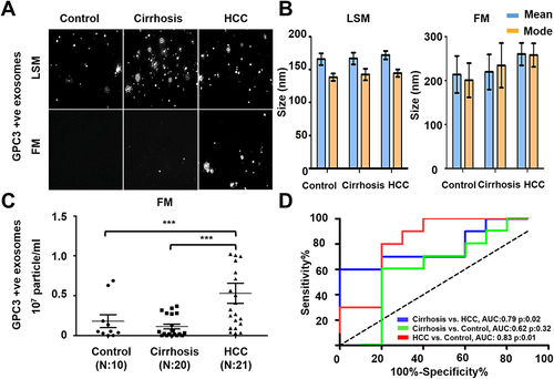 Figure 6 Quantification of GPC3+ve HCC exosomes using fluorescent-nanoparticle tracking analysis (F-NTA). Ten microliters of serum samples were diluted in 100 μL of PBS with 1% BSA. Antibody incubation was performed at 4 °C overnight. The next day samples were diluted in 1mL of ultrapure water and passed through a gel-filtration column. Samples were further diluted (1:10) in 1mL water and analyzed by NTA using light scattered mode (LSM) and fluorescence mode (FM). (A). Representative video image of Extracellular vesicles (EVs) analysis captured in LSM and FM of immunocaptured using PE-conjugated GPC3 antibody. (B). Show the size (mean and mode) measured in LSM and FM. (C) Concentration measurement of immunocaptured EVs (particles/mL) using GPC3 antibody levels in normal, cirrhosis, and HCC serum detected using FM. The particle number obtained in FM was normalized with the particle number obtained in LSM for each sample. *** is representing the statistical significance level of p<0.001. (D). ROC analysis shows the sensitivity and specificity values of GPC3 vesicles in normal, cirrhosis, and HCC.