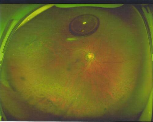 Figure 2 Retinal attachment on the 14th day postoperatively, with a small air bubble present in the vitreous cavity.