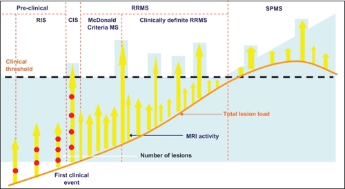 Figure 1 Attempts to identify disease activity earlier than clinically definite relapsing-remitting MS (RRMS) has resulted in the identification of “McDonald Criteria” MS, clinically isolated syndrome (CIS), and radiologically isolated syndrome (RIS) based around MRI.