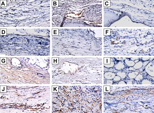 Figure 10 Immunohistochemistry analysis of von Willebrand factor expression in calvarial defects at 8, 10, and 12 weeks after implantation of bone graft substitutes.Notes: Calvarial defects implanted without bone graft substitutes were used as controls (magnification 400×). A–L show the higher magnification of the rectangle inset areas in Figure 9. Control group (A–C); CS group (D–F); CS/PLGA group (G–I); CS/SIM/PLGA group (J–L).