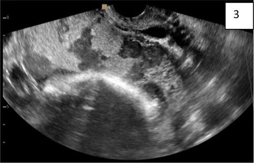 Figure 3. Sagittal transabdominal plan of abdominal invasive anterior placenta with interruption together with a uterus: serosa bladder face with irregular shape with different size, grade 3 lacunae, according to Finberg classification. The abnormal lacunae are mostly at the lower uterine segment under the hyperechoic line between the uterus and bladder. There are four typical markers: loss of ‘clear zone,’ abnormal placental lacunae, bladder wall interruption, and myometrial thinning.