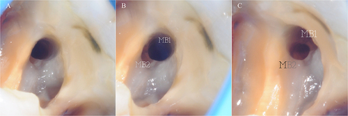 Figure 6 Intra-operative photos showing a particular anatomy of the mesio-buccal system of an upper first molar with different angulations.